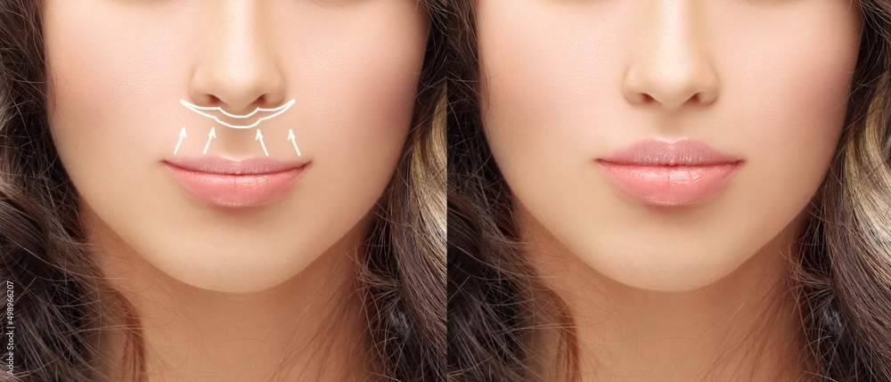 Lip Lift