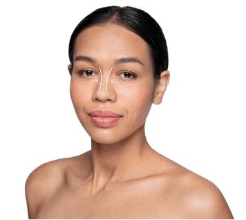 Rhinoplasty