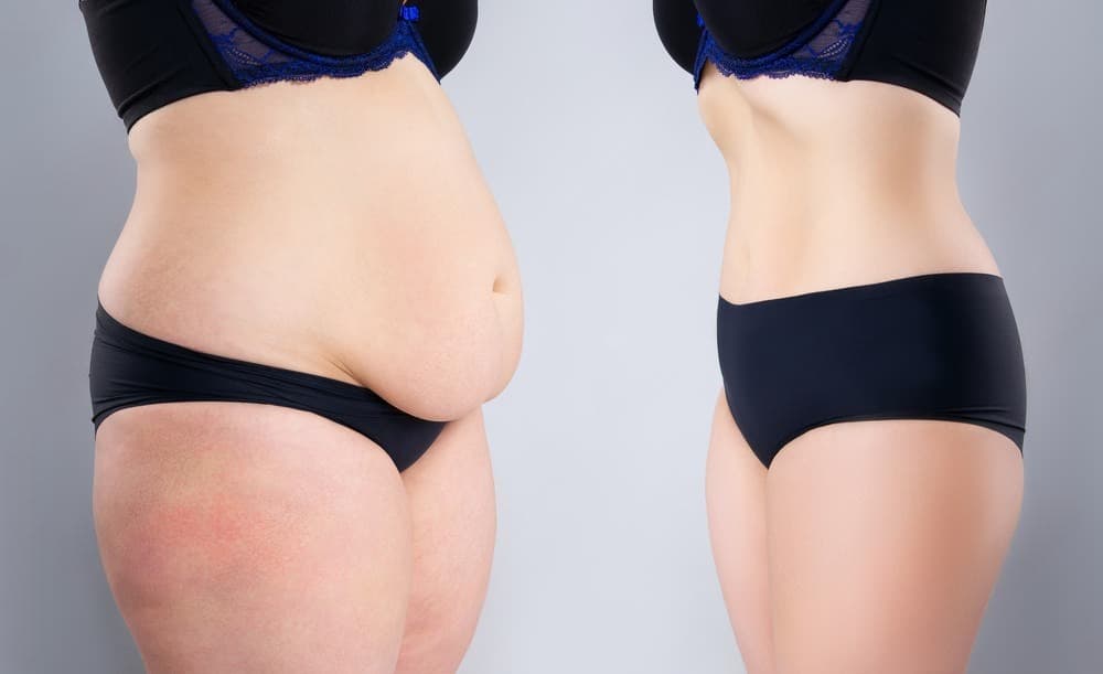 Tummy Tuck (Abdominoplasty)