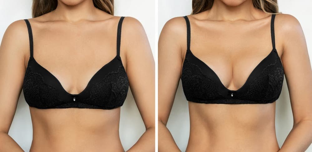 Breast Augmentation
