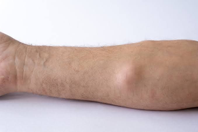 Lipoma Cysts Scars