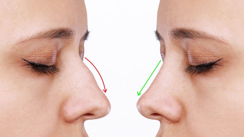 Rhinoplasty (Nose job)