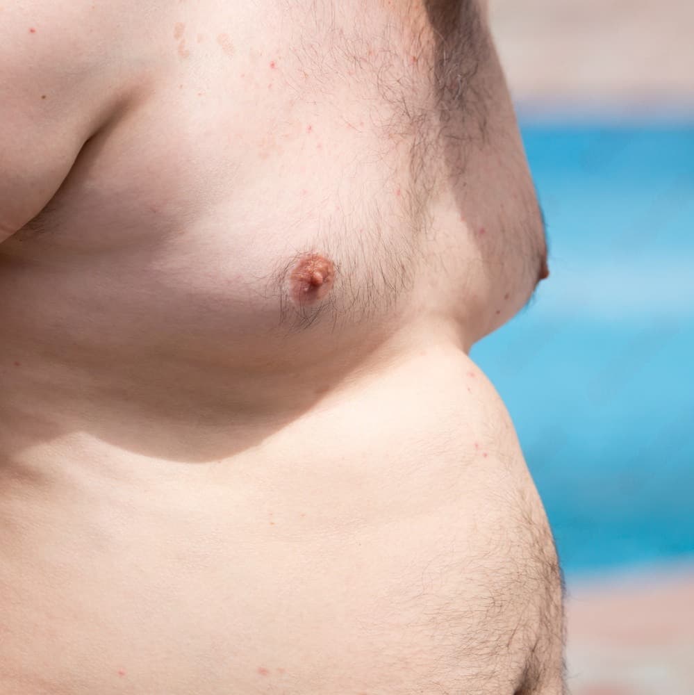 Gynaecomastia