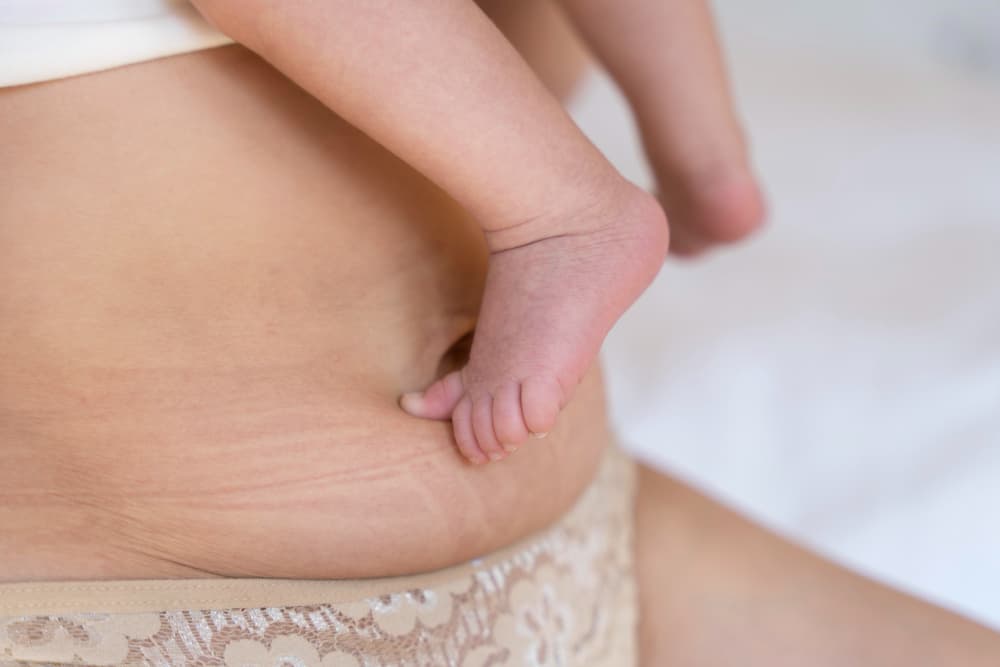 Post-Pregnancy Tummy Tuck (moms)