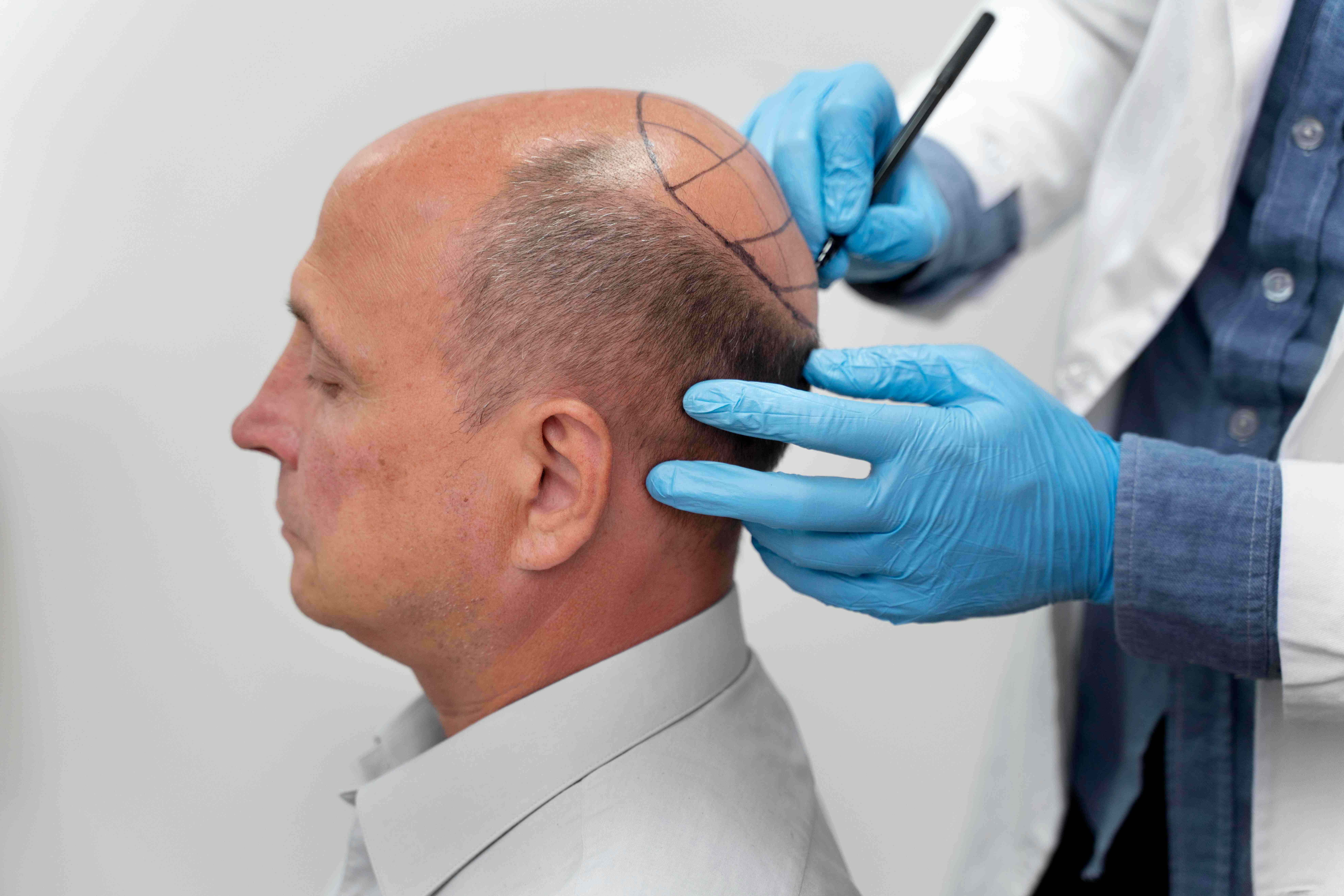 Top 5 Benefits of Hair Transplant Surgery